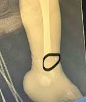 Artan Bebek Kemik Kırıkları ve Güvensizlik